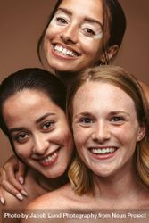 Smiling women with vitiligo, acne, and freckles bDNDp5