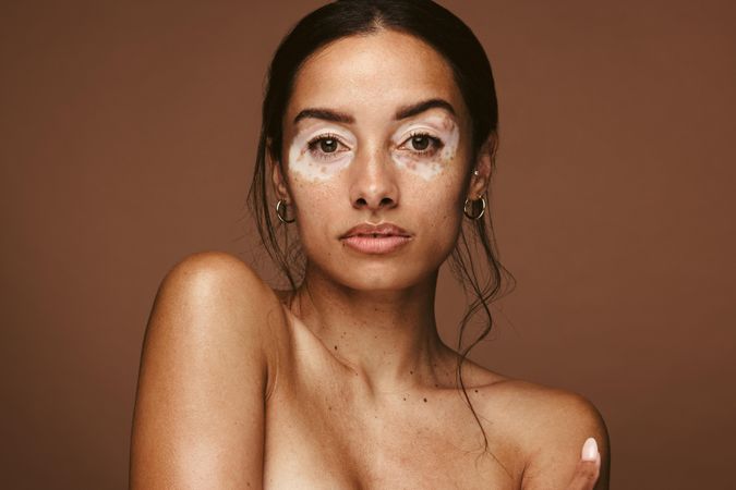 Beauty model with vitiligo looking at camera