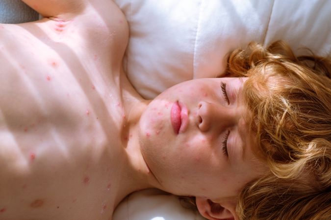 Boy with chickenpox sleeping peacefully