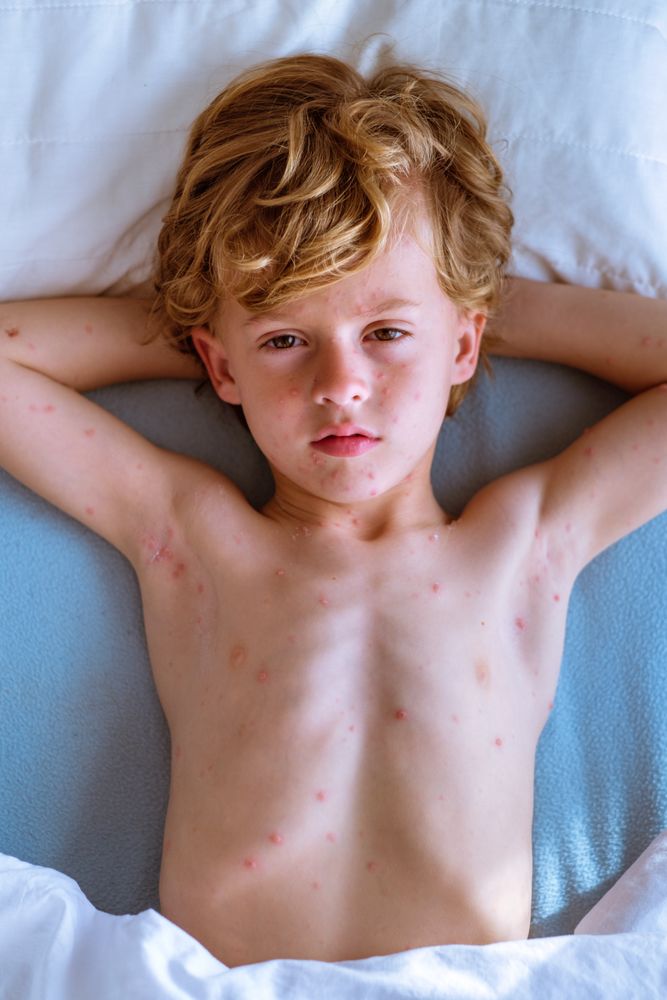 Boy with chickenpox holding hands behind head