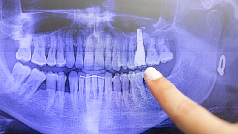 Detail of a digital dental x-ray of a patient's mouth, showing the teeth, jaws and a dental implant