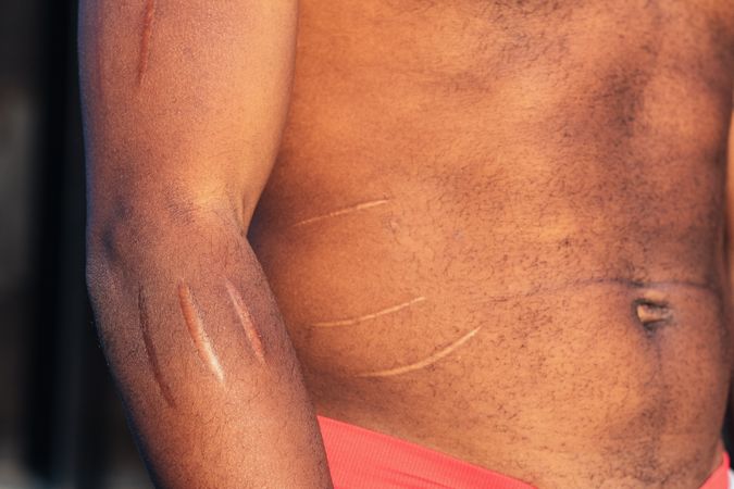 Crop man with scars on body