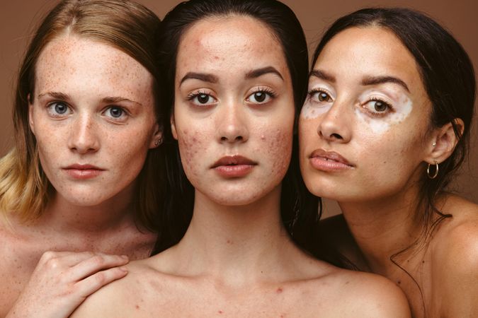Young women with diverse skin disorders like freckles, acne and vitiligo