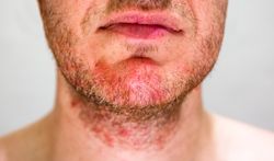 Man with seborrheic dermatitis in the beard area