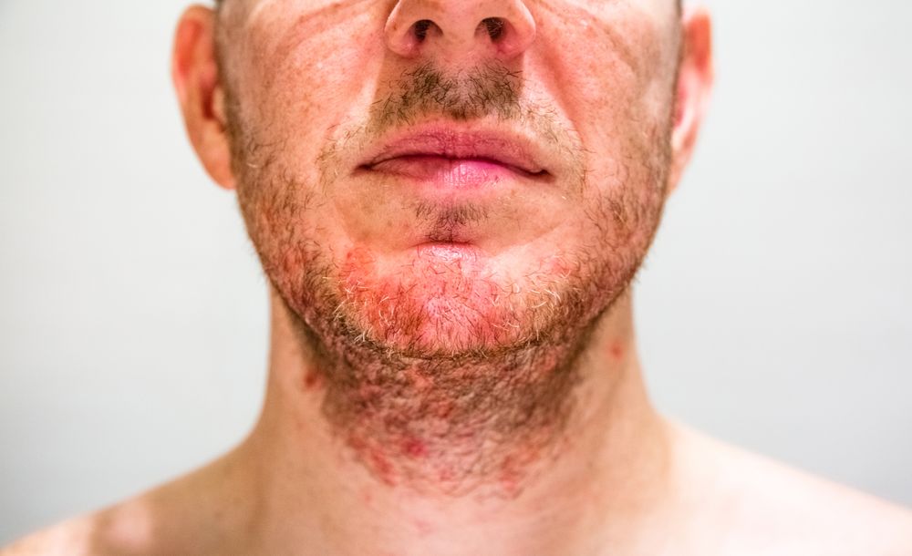 Man with seborrheic dermatitis in the beard area