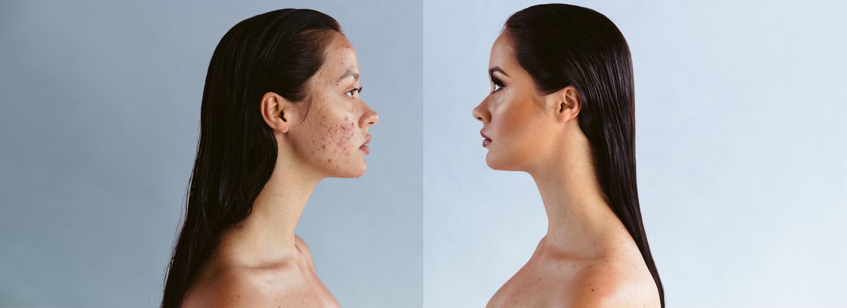 Before and after shot of woman suffering from adult acne