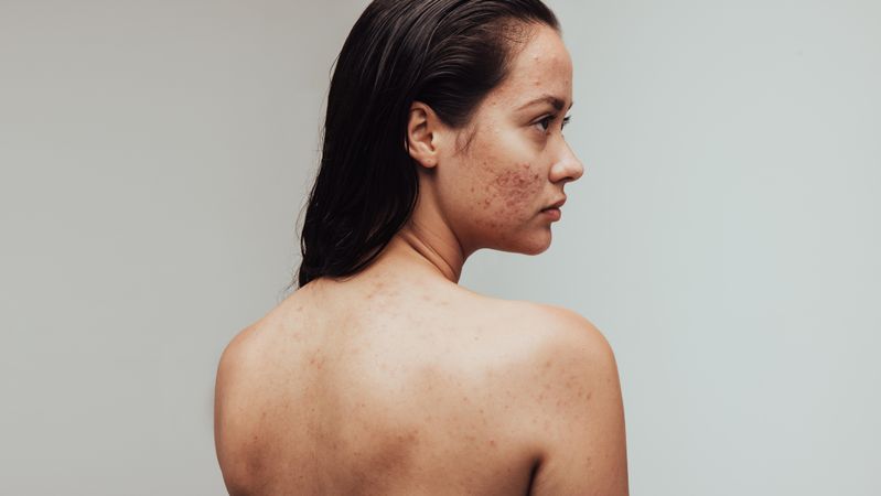 Portrait of woman having acne inflammation on face and body