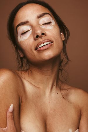 Close up of young woman with vitiligo near her eyes