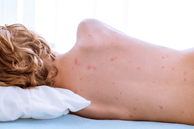 Anonymous boy with varicella disease on bed