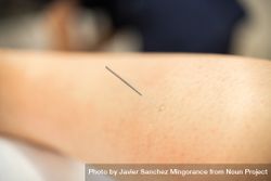 Acupuncture needle in patient’s 4jkPRb