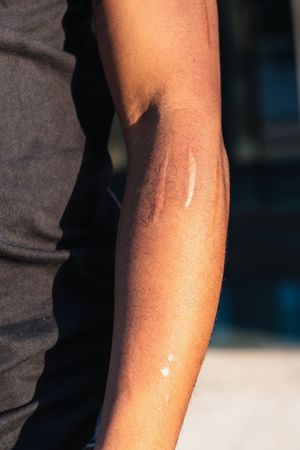 Faceless Black person with scars on arm