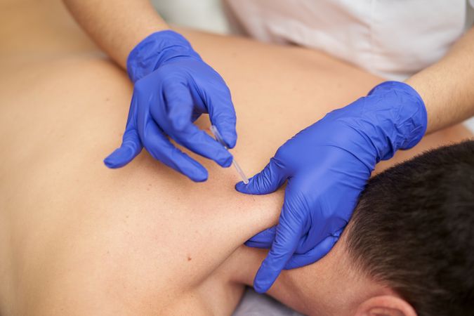 physiotherapist treating an overload with dry needling