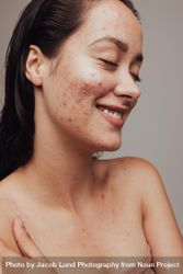 Close up of smiling woman with acne and pimples on face 5qYAo5