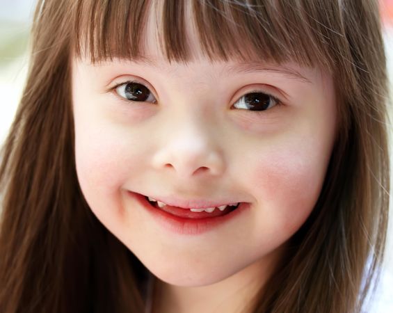 Closeup portrait of a young girl with Down syndrome