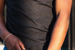 Faceless Black person with scars on arm