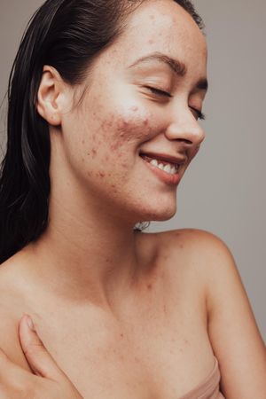 Close up of smiling woman with acne and pimples on face