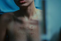 Portrait of a woman’s front with acne