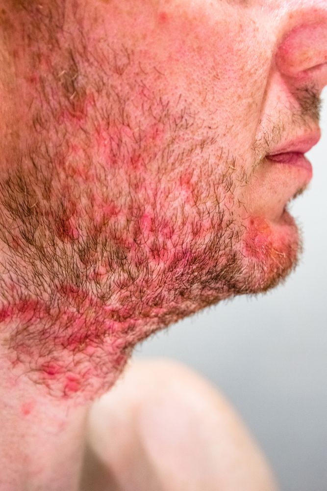 Man with seborrheic dermatitis in the beard area